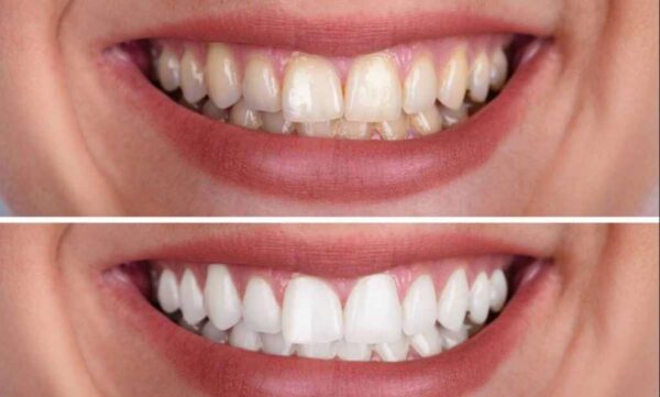 5 Ingenious Things You Can Do With Crest Whitestrips UK