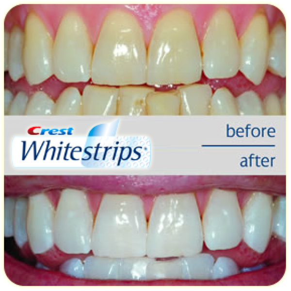 Crest Whitestrips: The Effective Solution to Whiten your Teeth