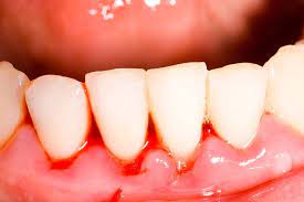 The Symptoms of an Infected Wisdom Tooth