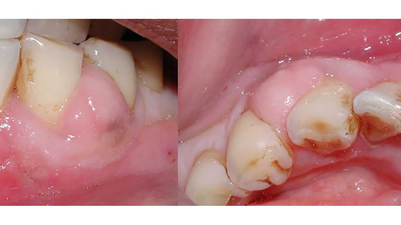 gum abscess treatment