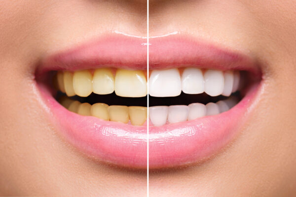 Functioning & Benefits of Crest Whitestrips