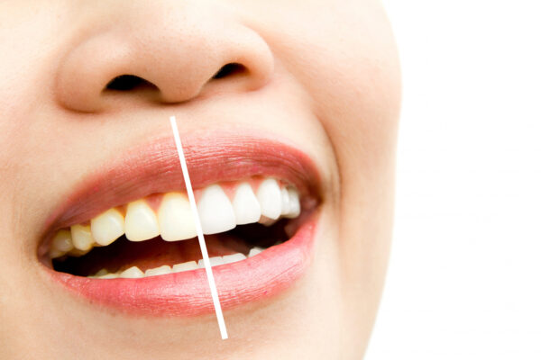 Beyond Teeth Whitening: What a Complete Smile Makeover Really Involves