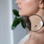 diagnosis of melanoma